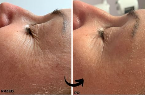 Efekt od razu po zabiegu bloomea